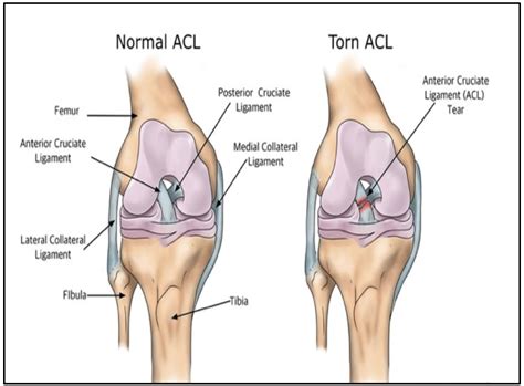 ACL Tear — PhysioFlow