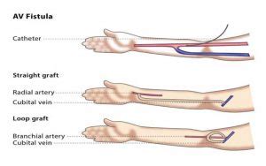 Arterio-Venous Fistula (AVF) creation for Haemodialysis - Cairns Vascular Clinic