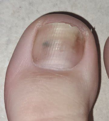 Dr dnd help - black spot under toenail | BabyCenter