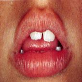 Incorrect tongue posture |MYOFUNCTIONAL THERAPY|ALLFORSPEECHallForSpeech
