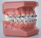 Braces at best price in New Delhi by Noble Dental Care- Implant & Orthodontic Centre | ID ...