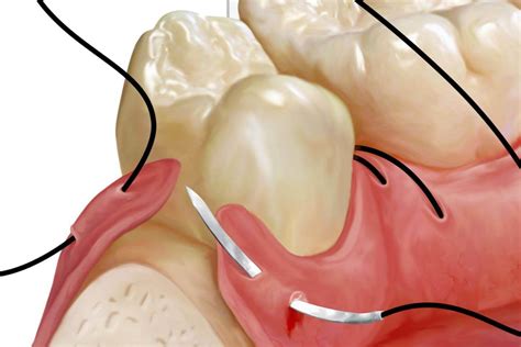 How to Tell if Your Wisdom Teeth Stitches Are Infected - afterva - Oral Health Library