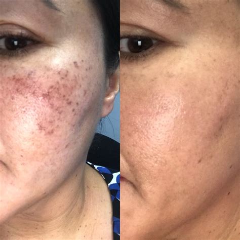 Is Microneedling Permanent For Acne Scars? - Medicine Acne