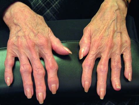 Osteoarthritis of the Hand - Bone, Joint, and Muscle Disorders - MSD ...