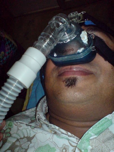 Obesity,Diabetes and Sleep Apnea: Effect of CPAP and Surgery