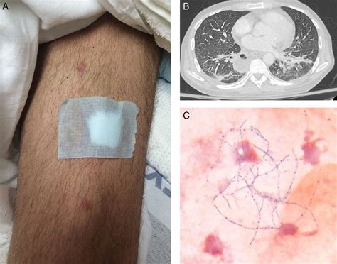 Unusual presentation of disseminated Nocardia abscessus infection in a patient with AIDS | BMJ ...