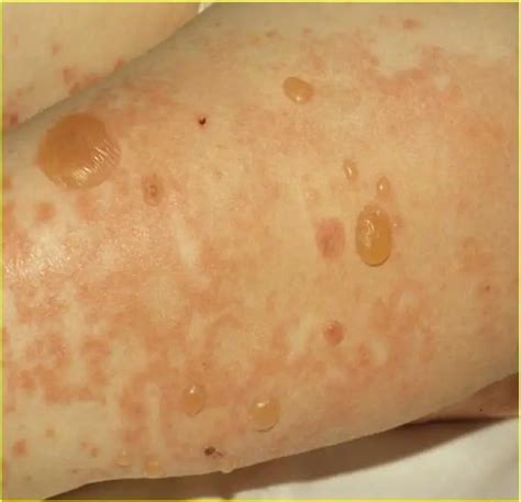 Bullous pemphigoid: symptoms, treatment and photos | Diseases and conditions 2024