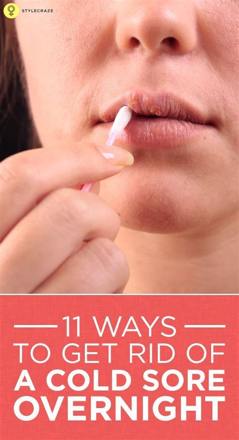 How To Get Rid Of Cold Sores – 20 Home Remedies And Other Treatments | Cold sore, Get rid of ...