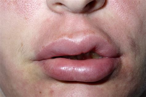ANGIOEDEMA – Dermatology Conditions and Treatments