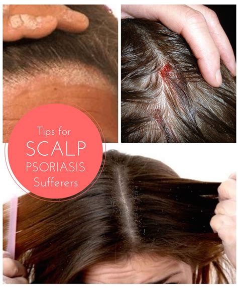 How To Prevent Scalp Irritation From Hair Dye