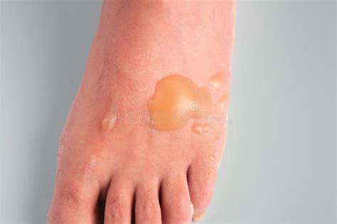 Burn Blisters on a Man`s Foot Caused by Boiling Water Accident. it`s an ...