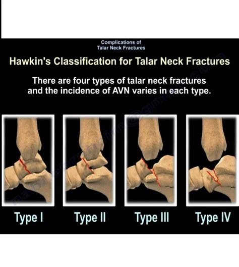 Complications of Talar Neck Fractures — OrthopaedicPrinciples.com