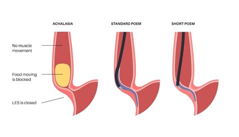 Premium Vector | Peroral endoscopic myotomy POEM minimally invasive procedure Disorder of the ...