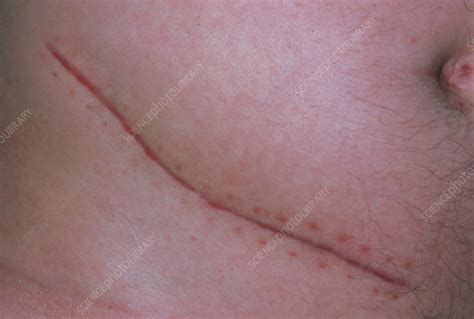 Appendicectomy scar - Stock Image - M332/0001 - Science Photo Library