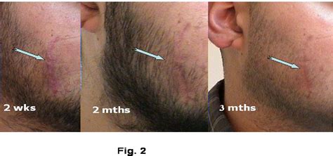 Figure 1 from MOISTURE AND WOUND HEALING | Semantic Scholar