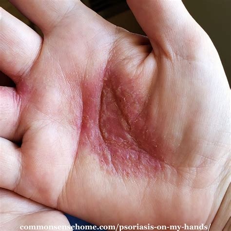 Psoriasis on My Hands - Causes & Remedies