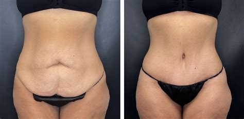 Abdominoplasty Decoded: Understanding The Tummy Tuck Procedure ...