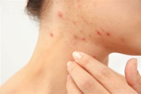 Neck Acne: What It Means, Treatment, Prevention and More