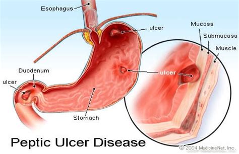 How To Detect Stomach Ulcer - Gearboot7