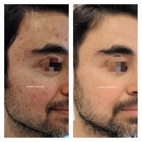 Chemical Peels in Mumbai - Cost, Before After Results, Side Effects