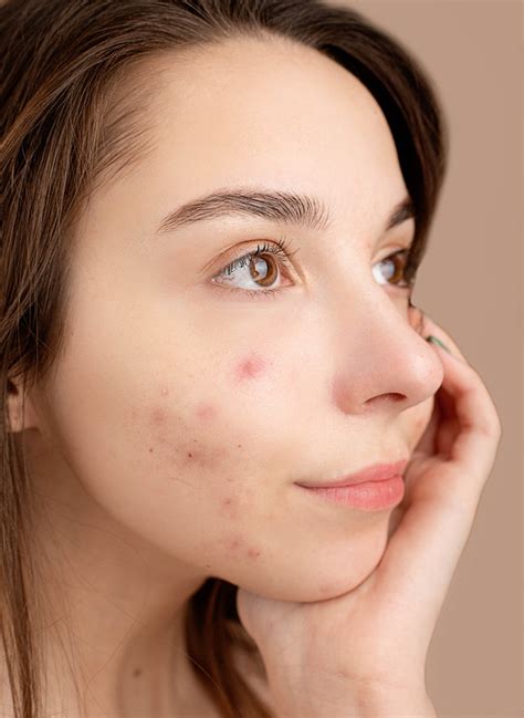 Acne Treatments That Work For Acne Scars - Acne Scar Remedies