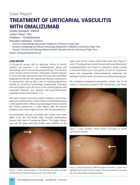 (PDF) TREATMENT OF URTICARIAL VASCULITIS WITH OMALIZUMAB