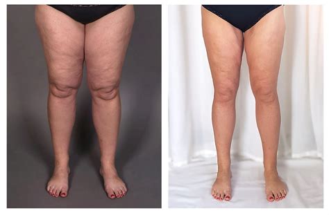 What Are the Signs and Symptoms of Lipedema? - StoryMD