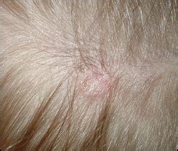 Cancerous Scalp Lesions