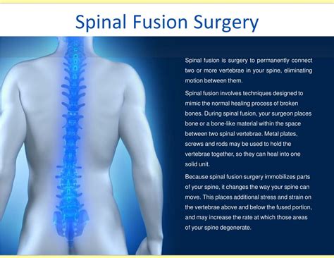 PPT - Spinal Fusion Surgery PowerPoint Presentation, free download - ID ...