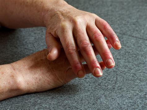 Early Rheumatoid Arthritis Hands - EsHealthTips