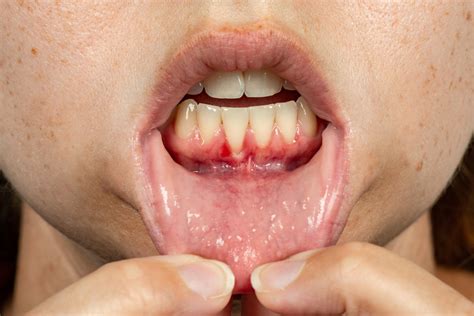 Why do My Gums Bleed When I Floss? - McCarl Dental Group
