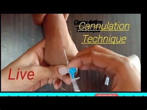 Cannulation insertion technique || cannula Procedure || intravenous ...