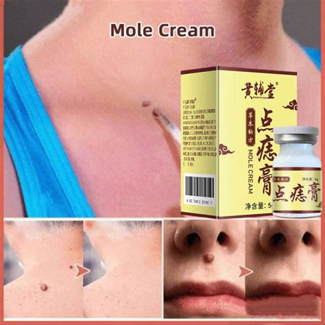 Mole Cream Skin Tag Removal Cream No Mark Remove Painless Remove Moles Dark Spots | Lazada Singapore