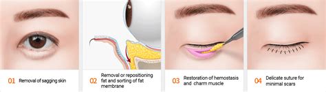 Eye Bag Removal Surgery in Singapore | Dream Plastic Surgery