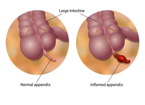 Perforated Appendix