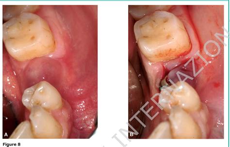 Purulent Exudate Teeth