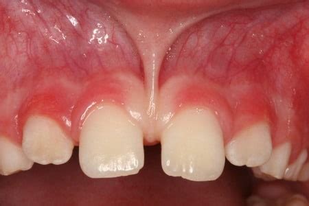 Labial Frenulum Normal