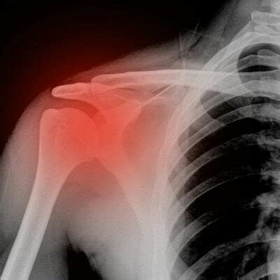 Shoulder Fracture | Shoulder Specialist | South Windsor, Rocky Hill ...