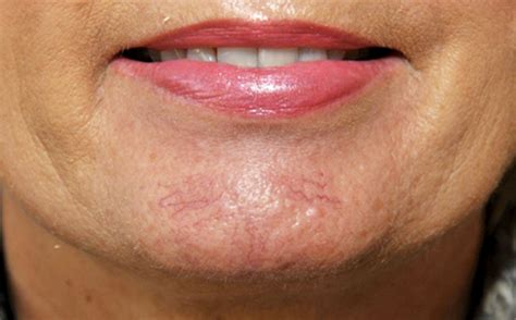 Laser for Blue Veins on Face – Cosmetic Surgery Tips