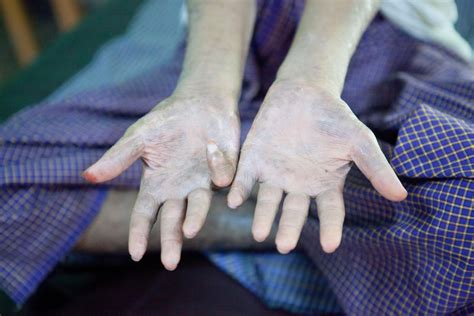 What is leprosy, is there a cure and what are the symptoms and causes? All you need to know