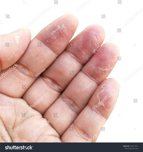 Eczema Fingertips