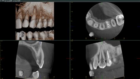 Internal Resorption Gaylord MI, Otsego Endodontics