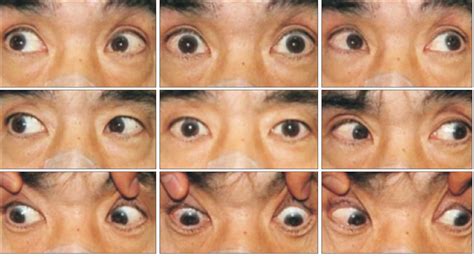 Figure 2 from Acute Pseudobulbar Palsy After Bilateral Paramedian ...