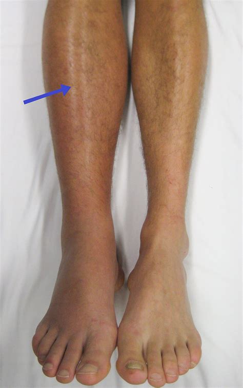 Medicine:Venous thrombosis - HandWiki