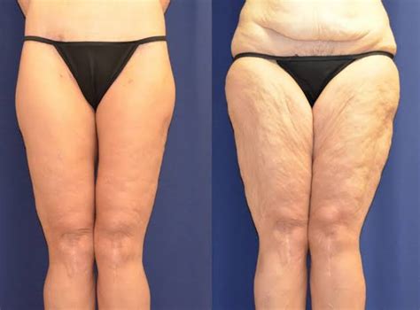 Liposuction Vs Cryolipolysis Differences And Side Effects – SKINFUDGE® - Center of Skin & Hair ...