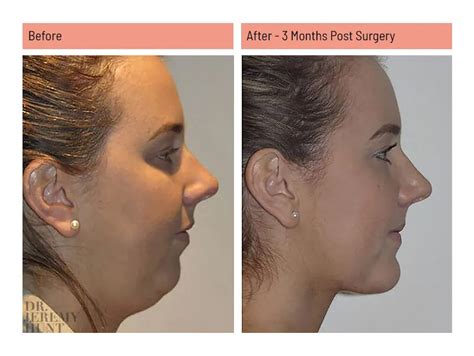 Mandibular Prognathism Before After