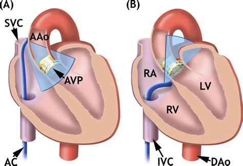 Intracardiac Echocardiography: A New Guiding Tool for Transcatheter ...