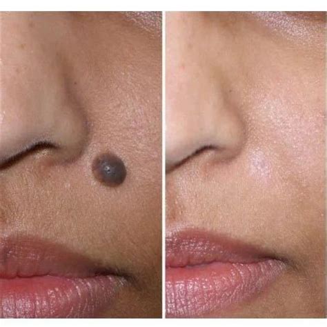 Mole Removal Surgery at best price in Aligarh by Cosmetic Surgery ...