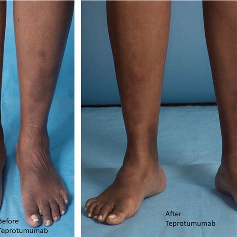 Showing pretibial myxedema before and after teprotumumab. | Download Scientific Diagram