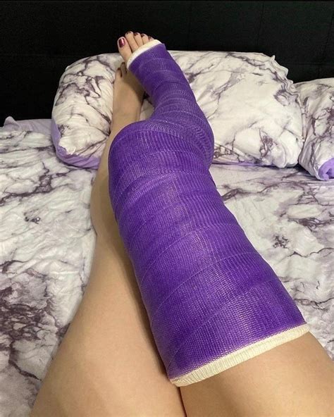 Always loved a purple cast! | Leg cast, It cast, Long leg cast